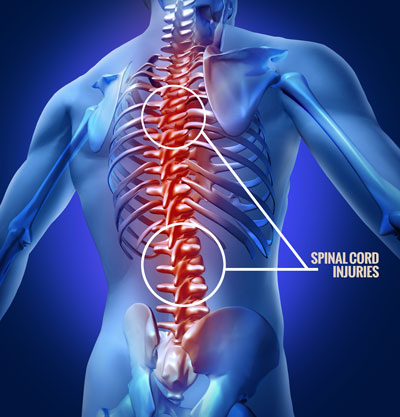 auto accident injuries causing spinal cord injuries