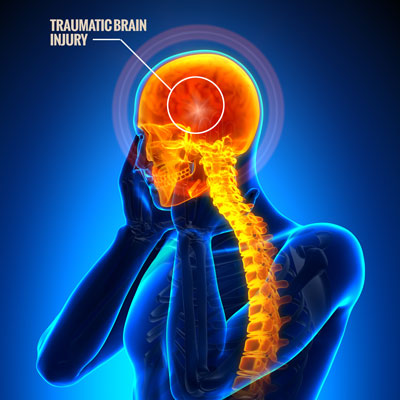 What Is My Traumatic Brain Injury Worth?